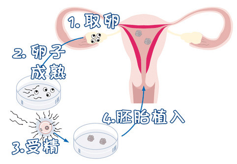 试管代怀生子助孕代妈